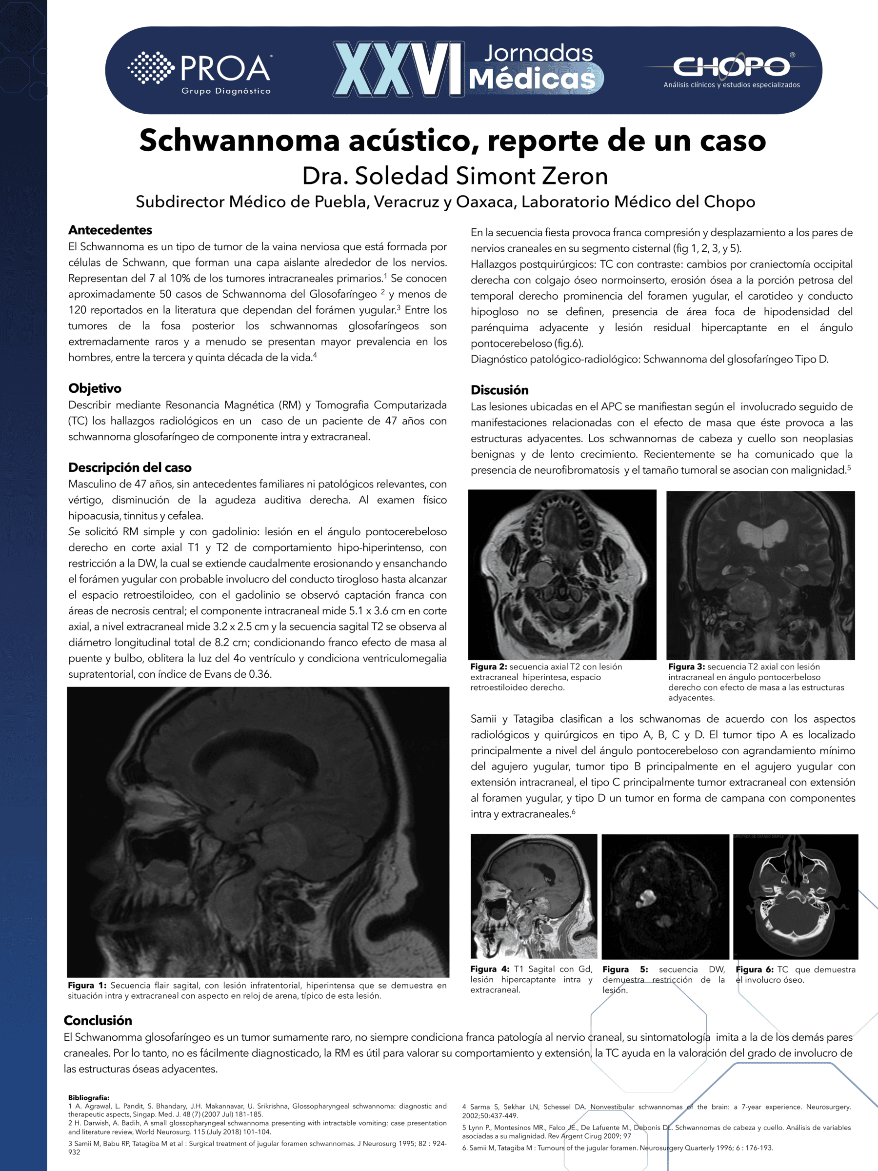 Schwannoma acústico, reporte de un caso