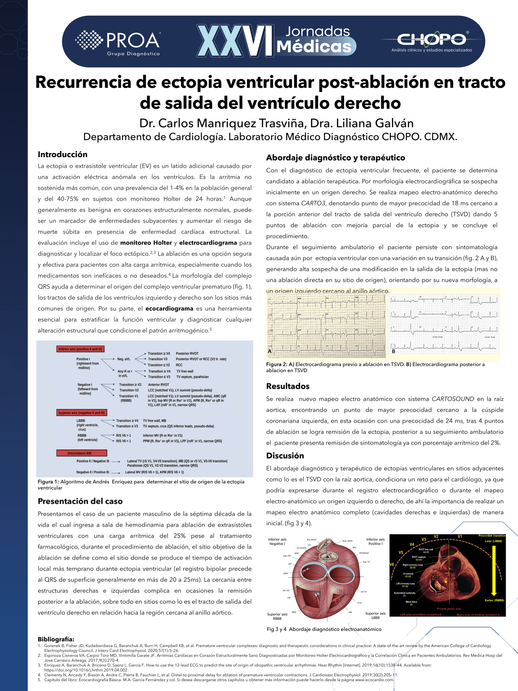 Recurrencia de ectopia ventricular post-ablación en tracto de salida del ventrículo derecho